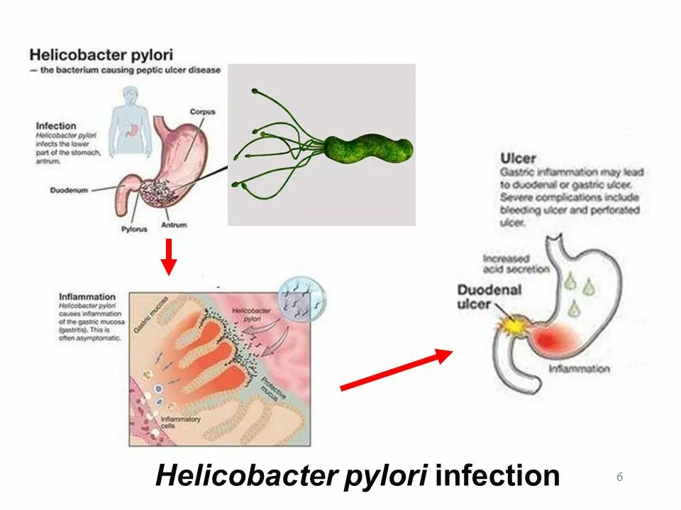 The link between ulcers and Helicobacter pylori infection